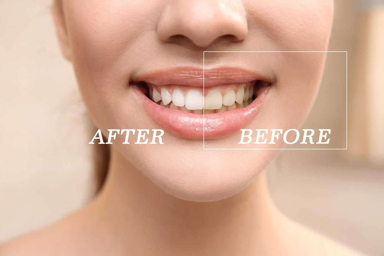 What Are the Most Effective Natural Teeth Whitening Methods You Can Try Carlisle?