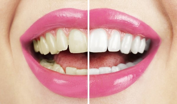 What Makes Ultima White Teeth Whitening Different Carlisle