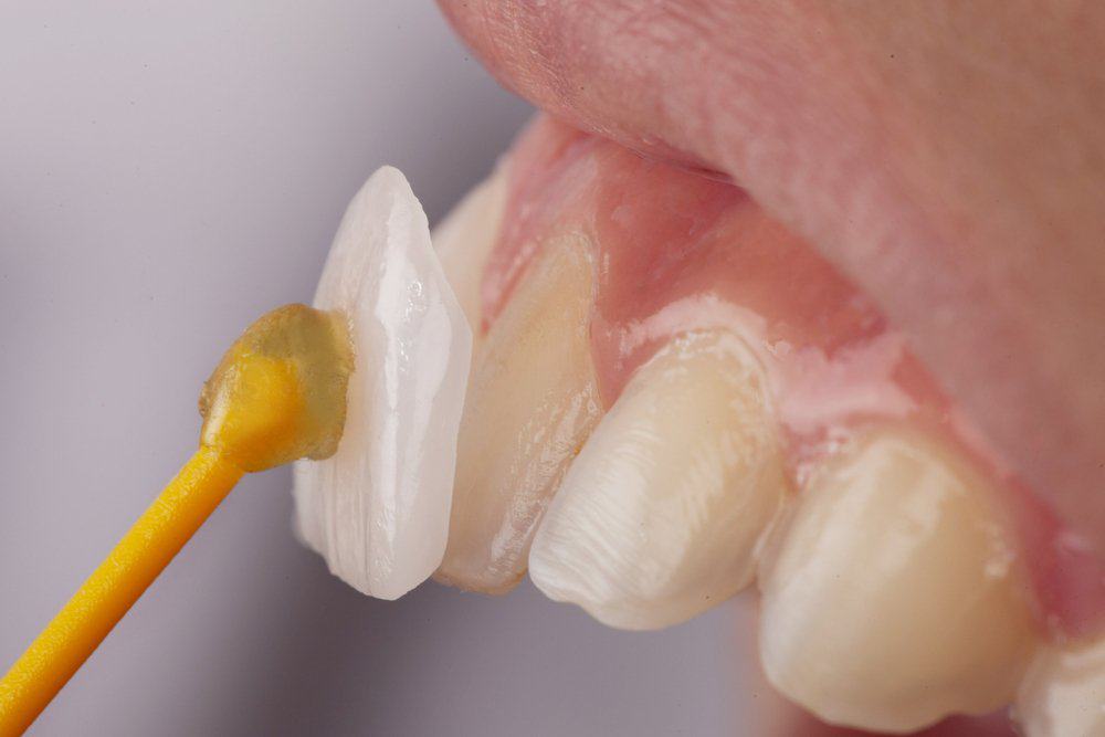 Dental Veneers: Achieving a Flawless Look Carlisle