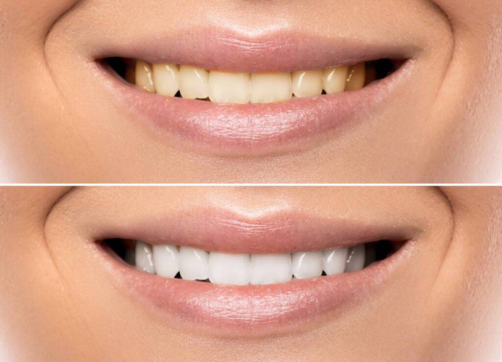 How Can You Protect Your White Smile as a Coffee Lover Carlisle?