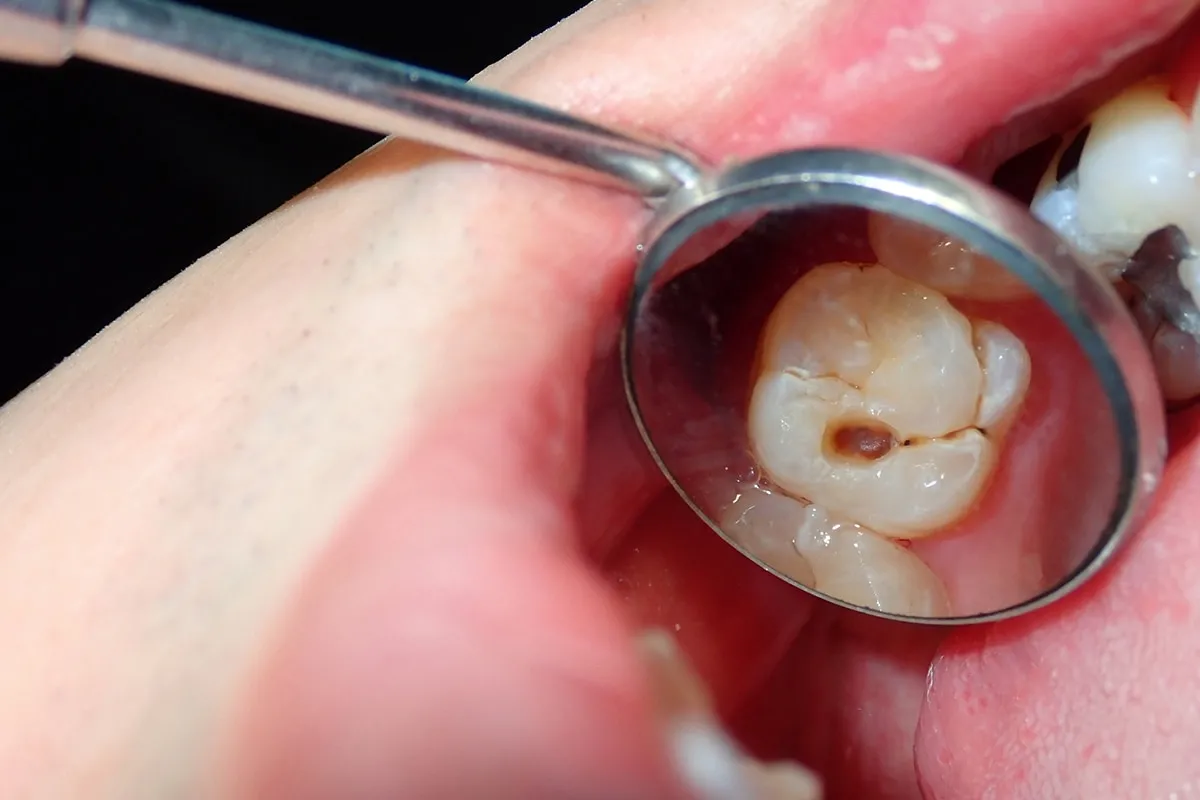Why Do Teeth Crack? Common Causes to Know Carlisle