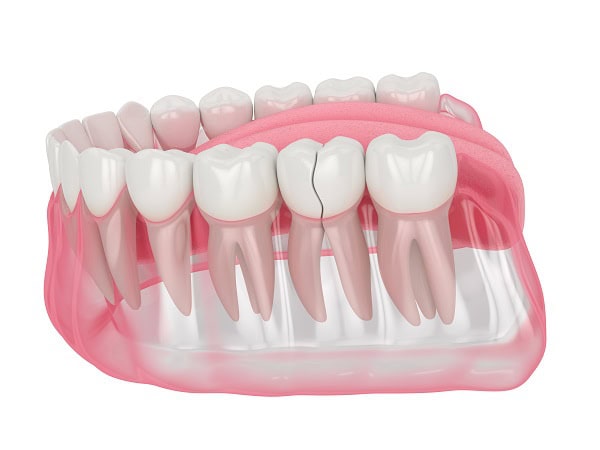 How Can You Manage Pain and Discomfort After a Root Canal Carlisle?