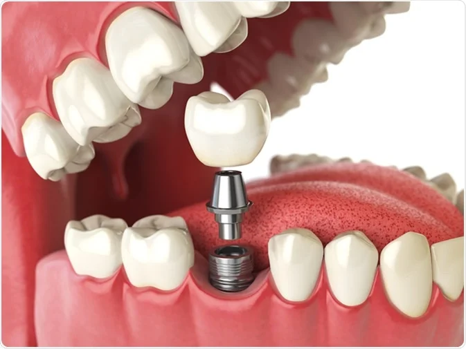 How Do I Decide Which Tooth Replacement Is Right for Me Carlisle?