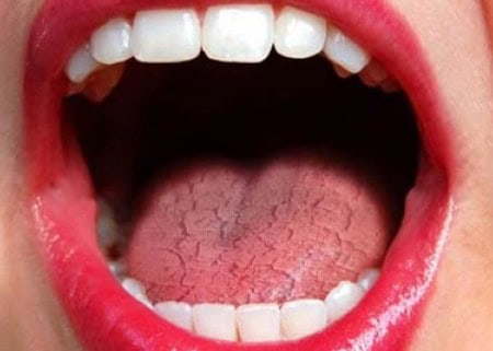 Dry Mouth and Its Role in Tooth Decay Carlisle