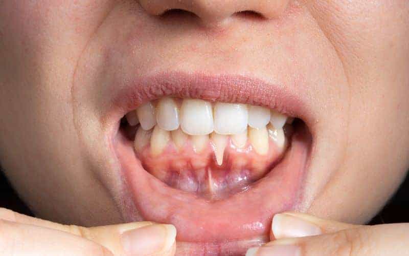 How Can Gum Disease Be Prevented Carlisle?