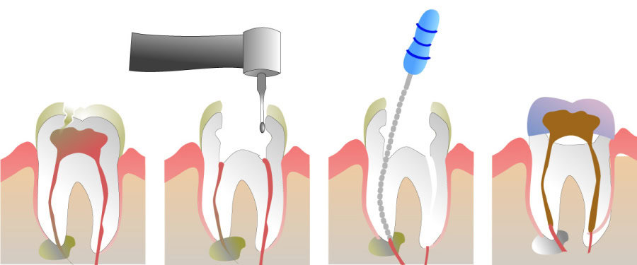 How Do You Properly Care for Your Teeth After a Root Canal Carlisle