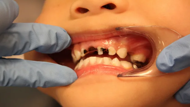 Which Foods and Drinks Cause the Most Damage to Young Smiles Carlisle?