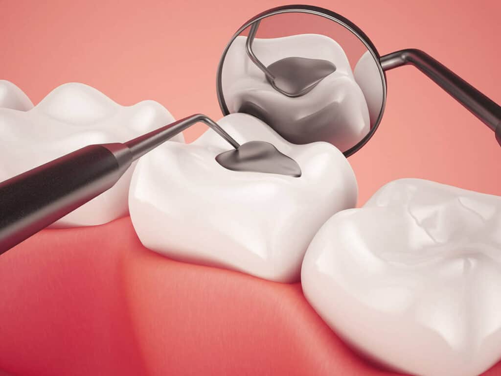 How Can You Prevent Tooth Decay Effectively Carlisle