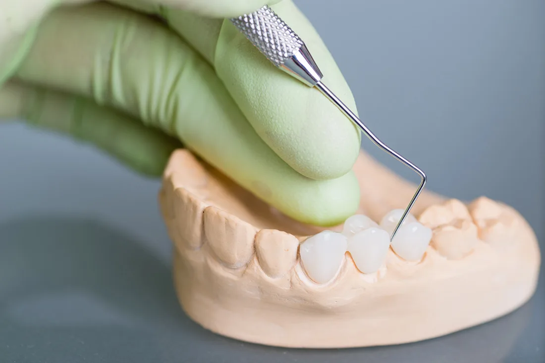 What Are the Different Types of Dental Crowns Available Carlisle?
