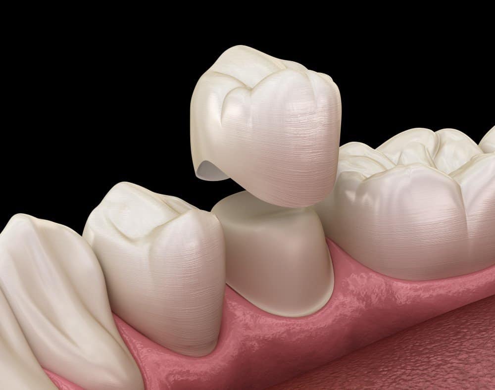 How Can You Prevent Common Dental Crown Problems Carlisle?