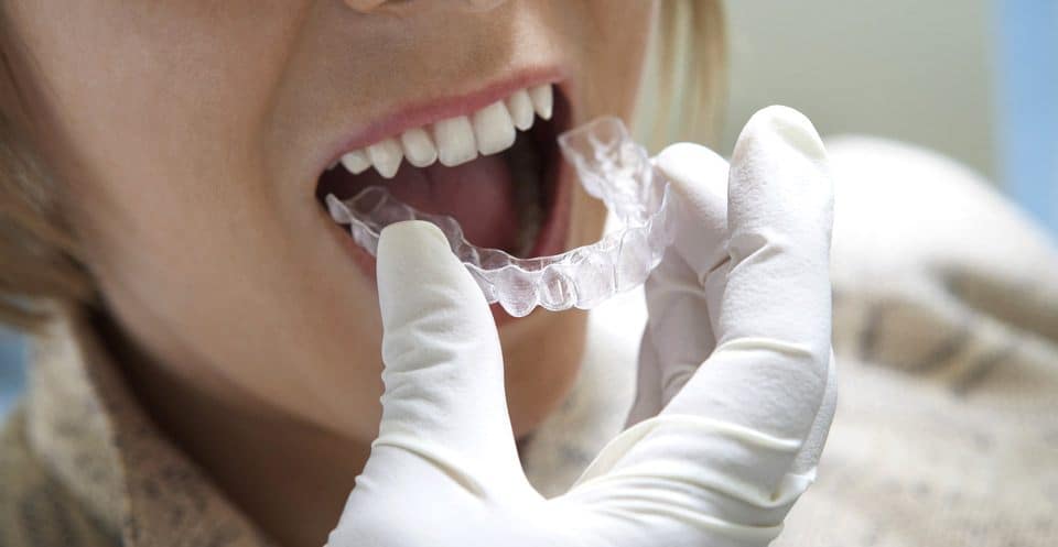Why Bleaching Trays Require More Time Carlisle
