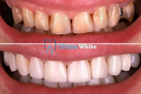 What Makes Instant Teeth Whitening Treatments So Popular Carlisle?