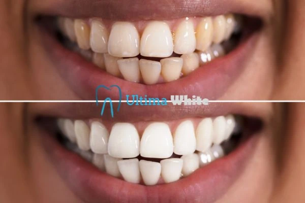 Aftercare Tips to Maintain Your New Smile Carlisle
